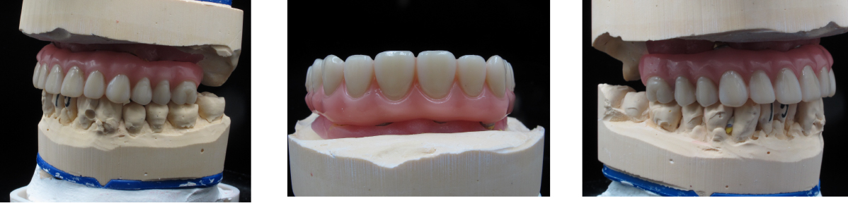 Maxillary Bar Supported Denture with 3D Scanning and Milling