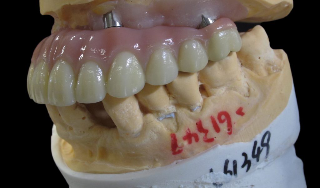 Upper 6-6 Implant Based Bridge thanks to 3D scanning