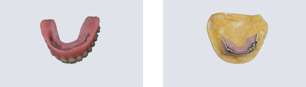 Bar & Overdenture with 3D scanning