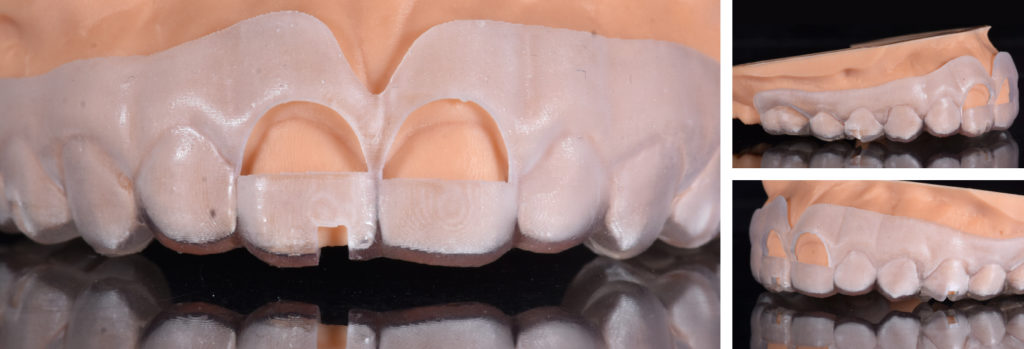 3D printed surgical guide for crown lengthening