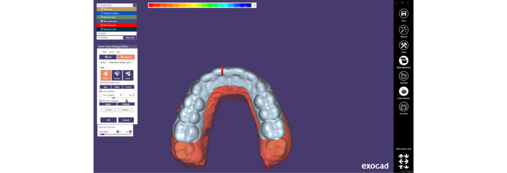 Designing a 3D model for surgical guide for crown lengthening