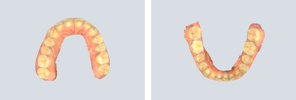 3D scanned data used to create a 3D model for surgical guide for crown lengthening