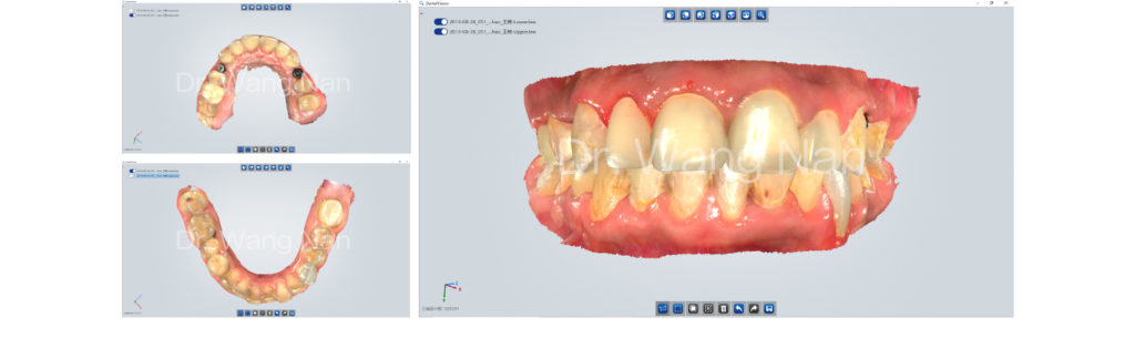 Acquiring intraoral data for the Digital Smile Design Workflow