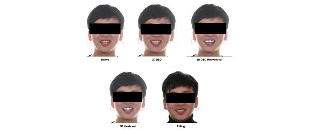 Digital Smile Design Workflow