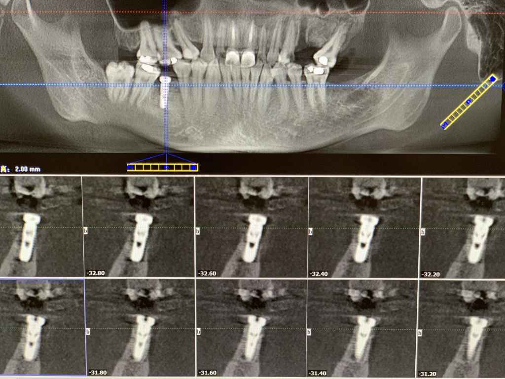Post-operative CT of the Narrow Diameter Implant in Posterior Mandible.