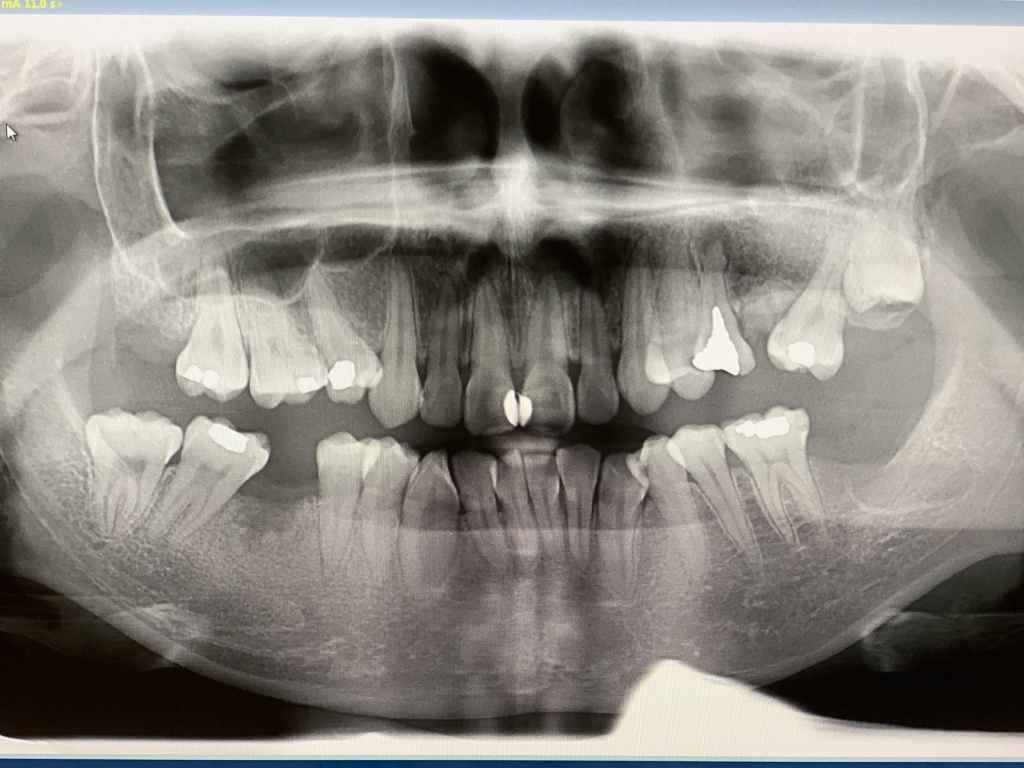 Pre-operative CT for the Narrow Diameter Implant in Posterior Mandible surgery