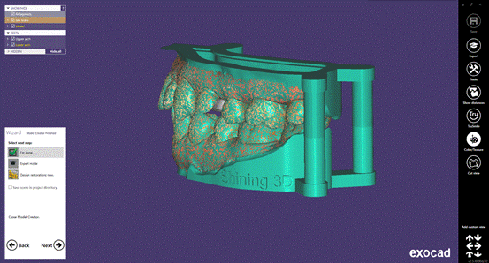 Exocad software design for Digitized Chairside Restoration