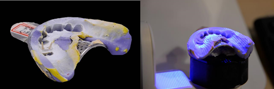 Dual Impression Post & Core Restoration Case 3D scanning with blue structured light