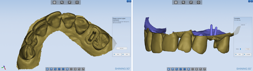 Dual Impression Post & Core Restoration Case 3D scanned data on exocad