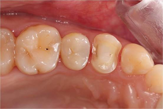 Preparing tooth n°24 for Digitized Chairside Restoration