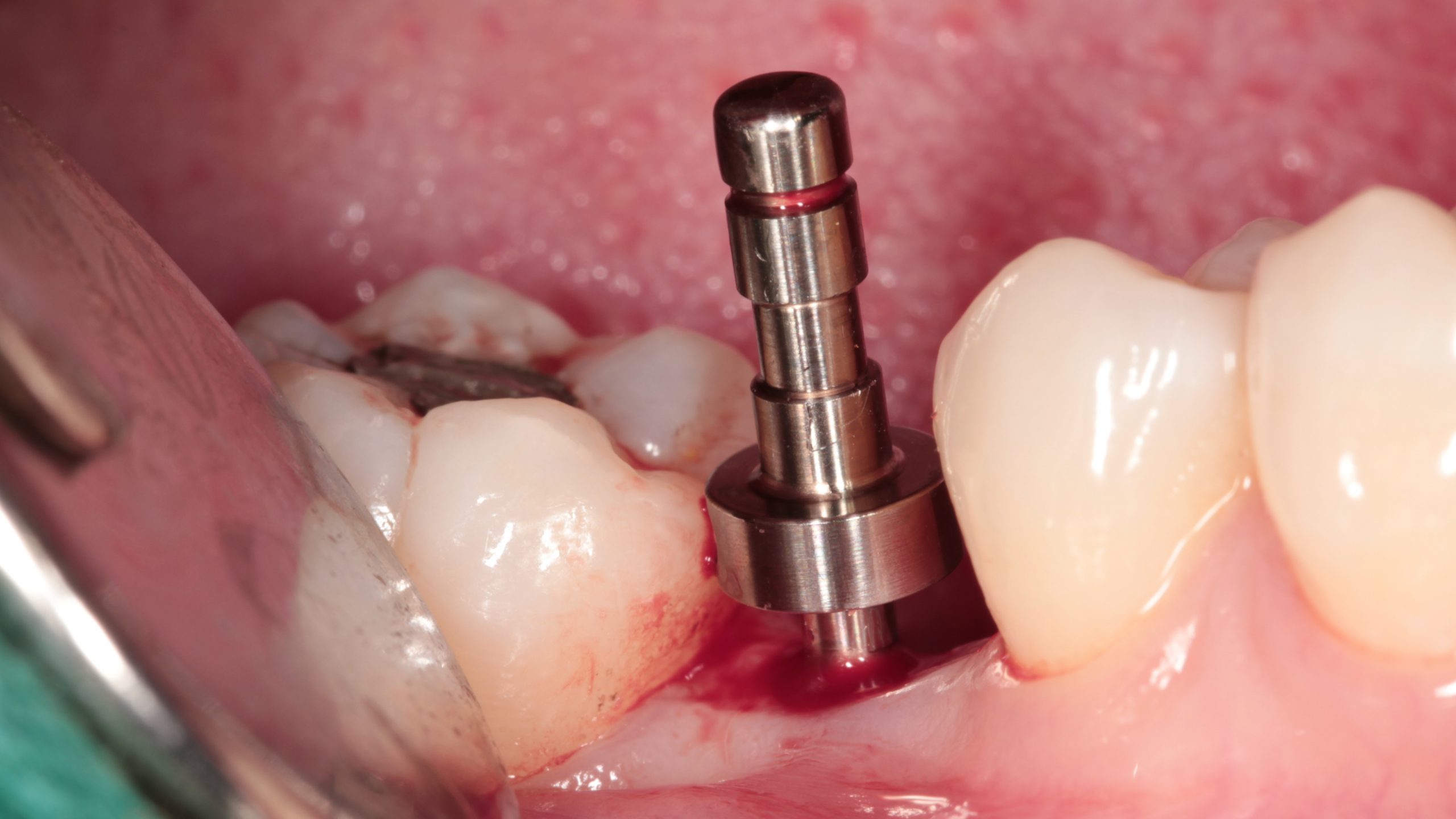 Implantology Between Narrow Posterior Teeth Digital Dentistry