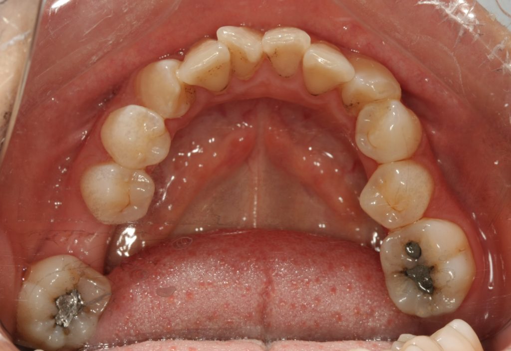 First look at the patient for the implantology between narrow posterior teeth
