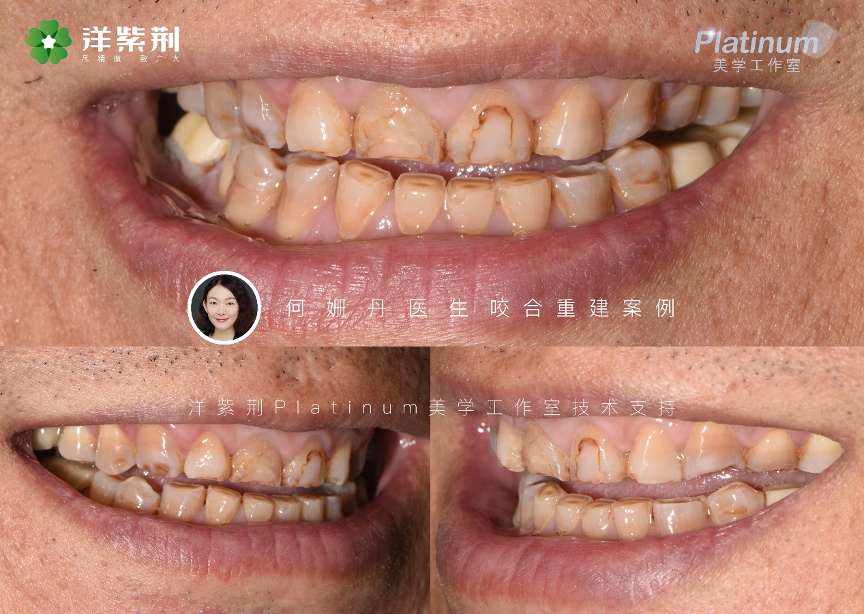 Before Occlusal Reconstruction