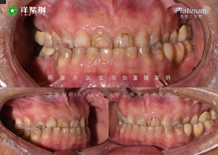 Teeth and gingiva before Occlusal Reconstruction