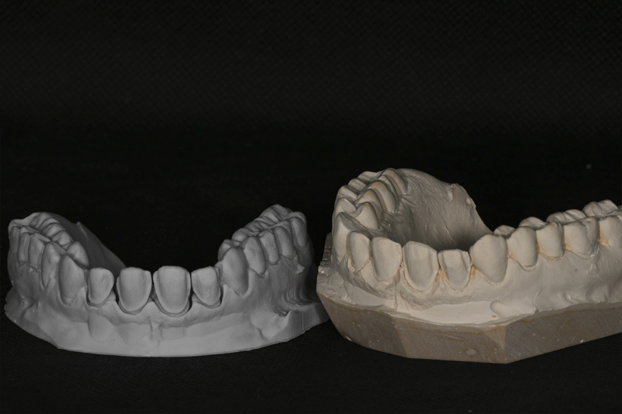 Plaster vs 3D printed models for refractory feldspathic veneers