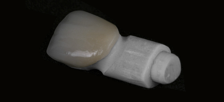 A 3D printed refractory feldspathic veneer