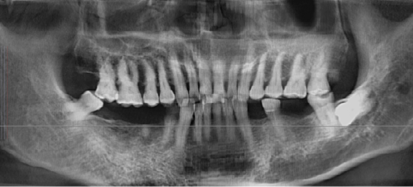 CBCT Before Implant Surgery with surgical guide