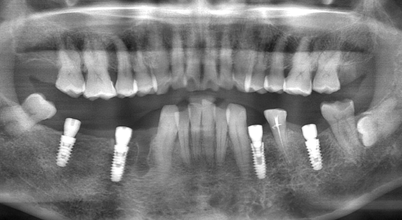 Result of Implant Surgery with surgical guide