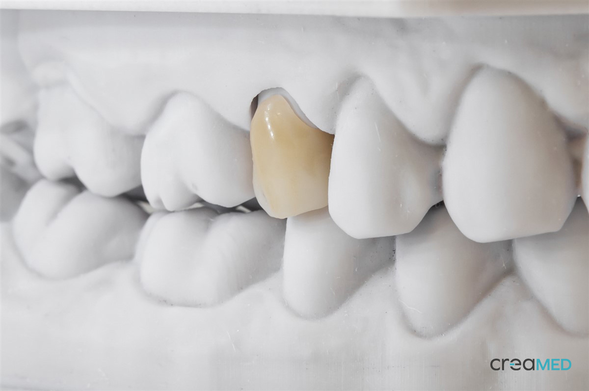 Permanent crown on post and core_CreaMed
