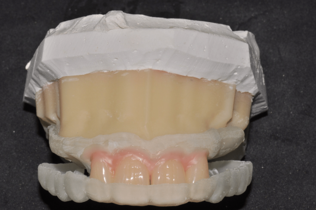 Teeth positioned in the 3D Printed Full Denture guide