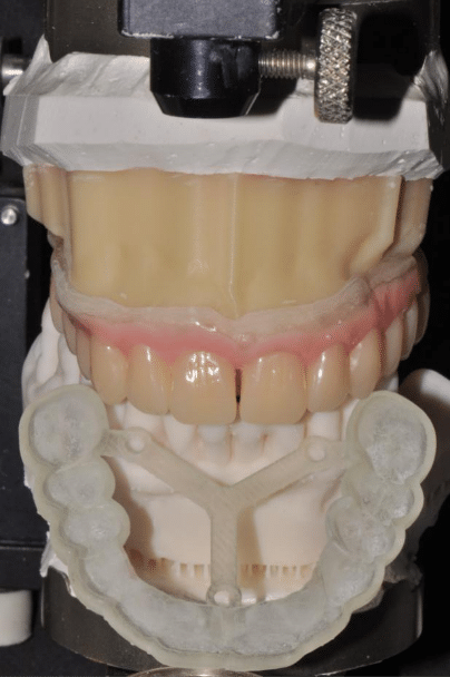 Checking the 3D Printed Full Denture in an articulator
