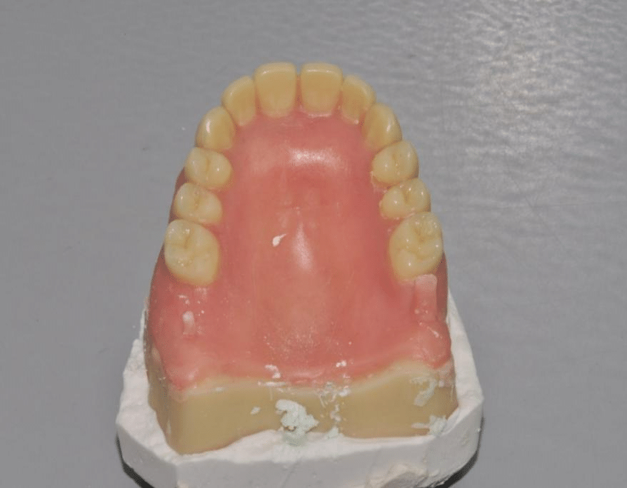 The result thanks to the 3D printed full denture guide