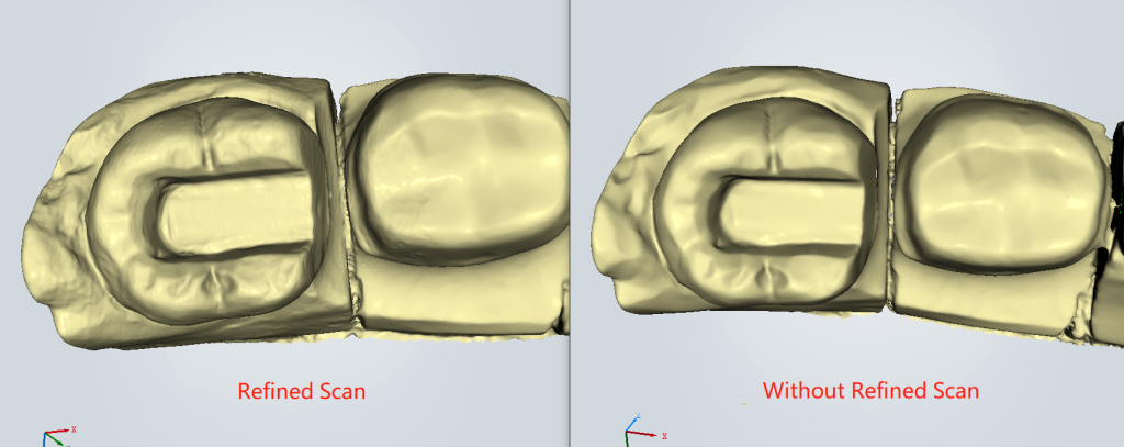 3D Scanning for IOS Inlay/Onlay Section refined vs non refined scan