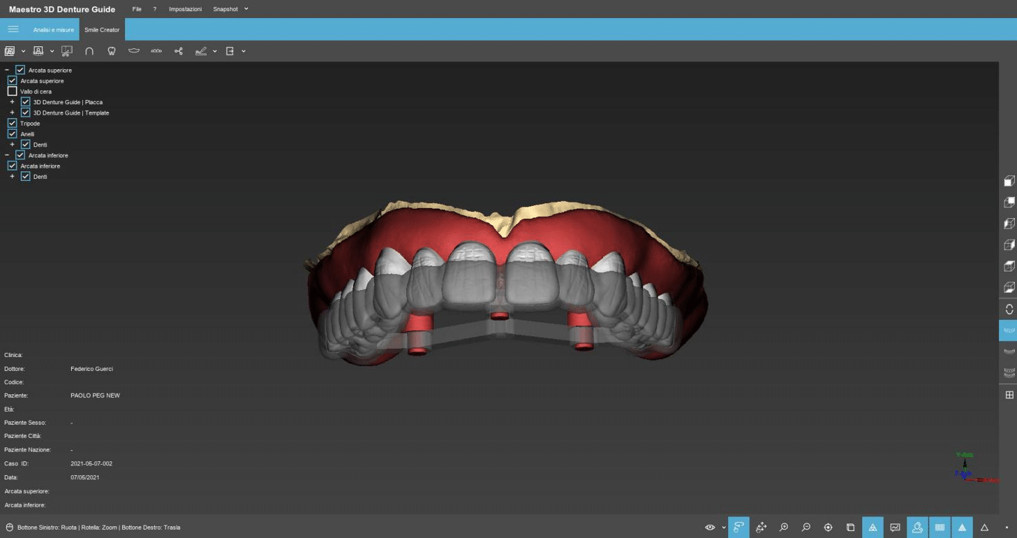 Smile Designed and 3D Printed Full Denture - shining3ddental.com