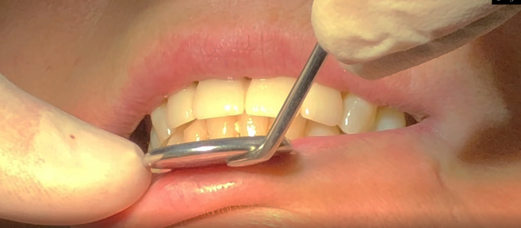 effective dental impression RM final result