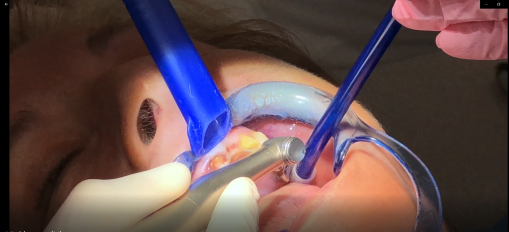 Start of the effective dental impression RM workflow