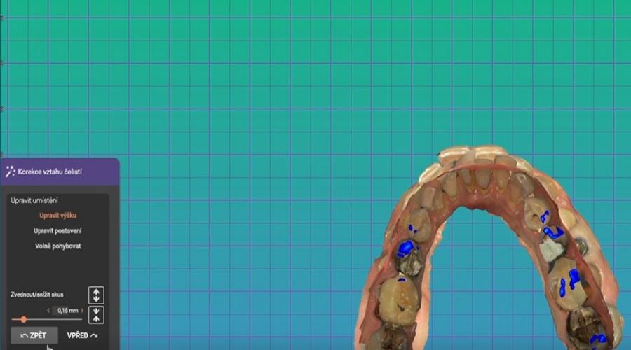 Adjusting the bite from the digital dental impression