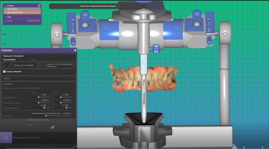 Virtual articulator in exocad for digital dental impression editing