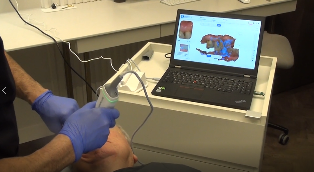 Bite 3D scanning for immediate implants