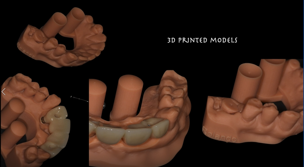 3D printing and 3D scanning for immediate implants
