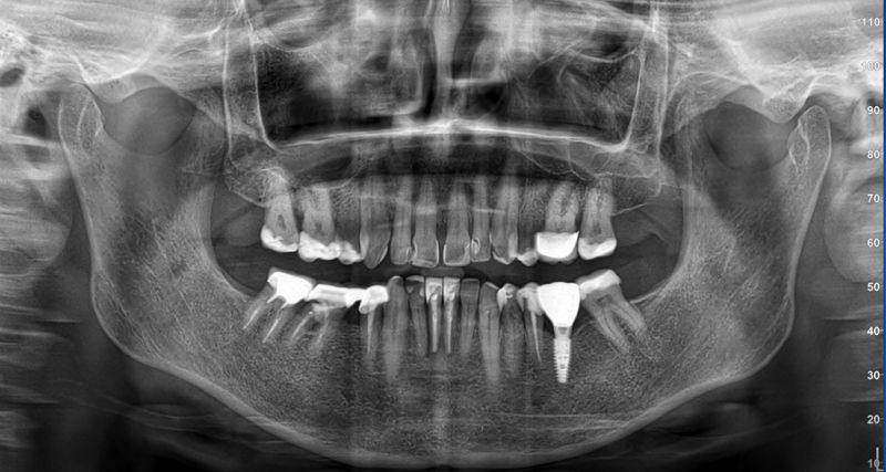 Patient CT scan before 3D Scanning in Immediate Loading