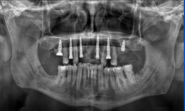 CT scan before using the 3D Scanner for Digital Implantology