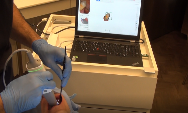 Using the Aoralscan 3 3D Scanner for Digital Implantology