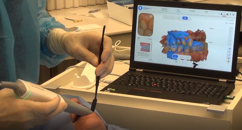 3D Scanning in Immediate Loading bite scan