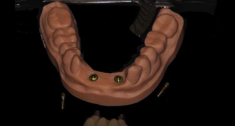 3D Scanning in Immediate Loading dental model