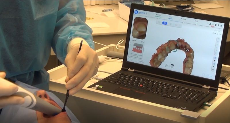 3D Scanning in Immediate Loading lower arch scan