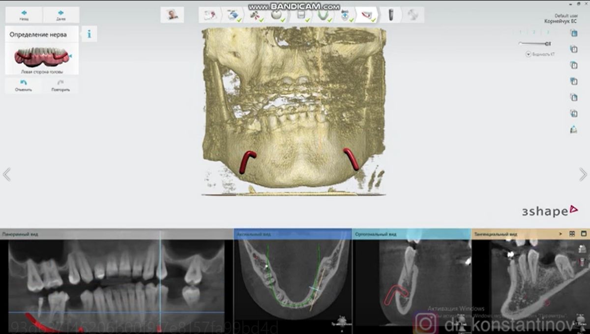 3D Printed Surgical Guide - 3D Scan and 3D Print with SHINING 3D