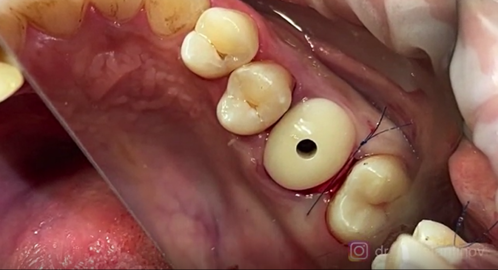 Precise drill hole thanks to the 3D Printed Surgical Guide