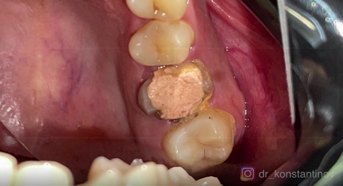 Initial patient state before creating the 3D Printed Surgical Guide