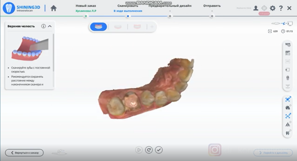 Intraoral data captured to create the 3D Printed Surgical Guide