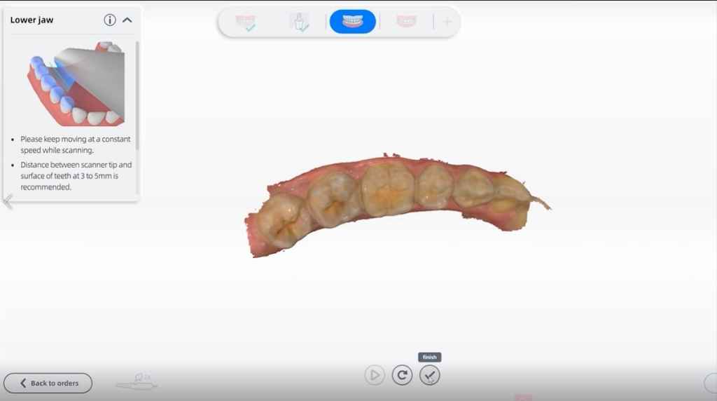 Lower arch Real-time scan for implant restoration