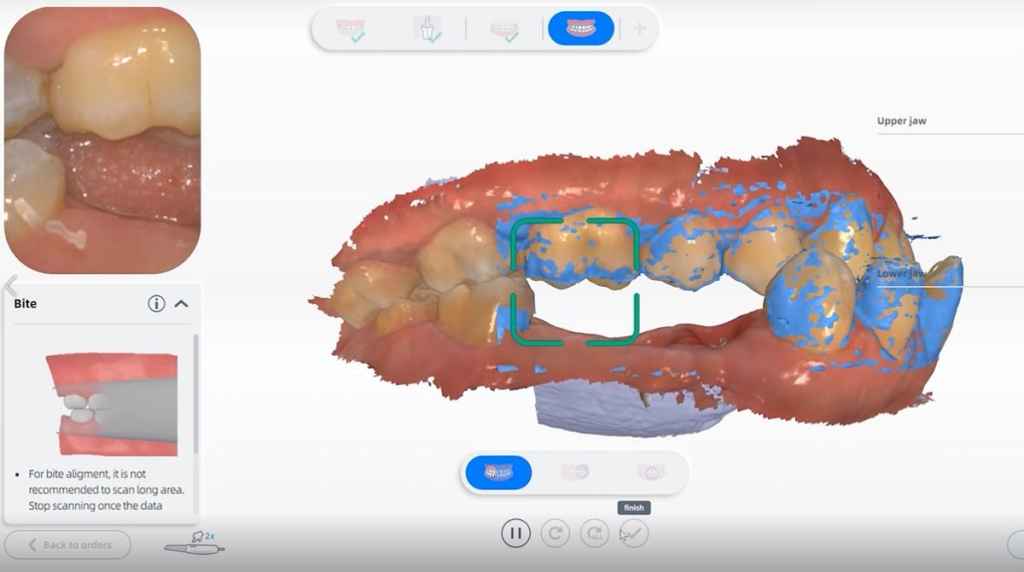 Real-time scan for implant restoration