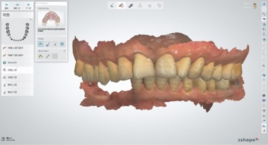 Full-color 3D dental data for unilateral distal extension edentulous restoration design