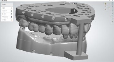 Model editing for unilateral distal extension edentulous