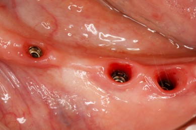 Gingival surgery before unilateral distal extension edentulous restoration