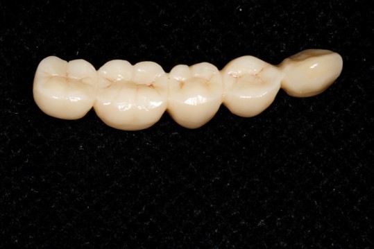 CAD/CAM milled restoration for unilateral distal extension edentulous patient